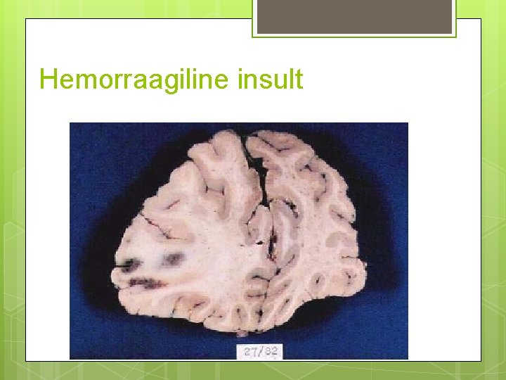 Hemorraagiline insult 