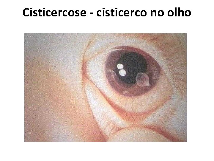 Cisticercose - cisticerco no olho 