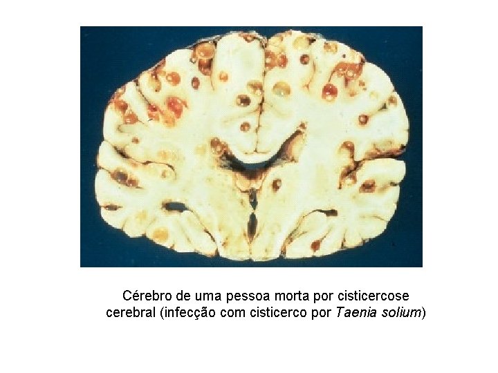 Cérebro de uma pessoa morta por cisticercose cerebral (infecção com cisticerco por Taenia solium)