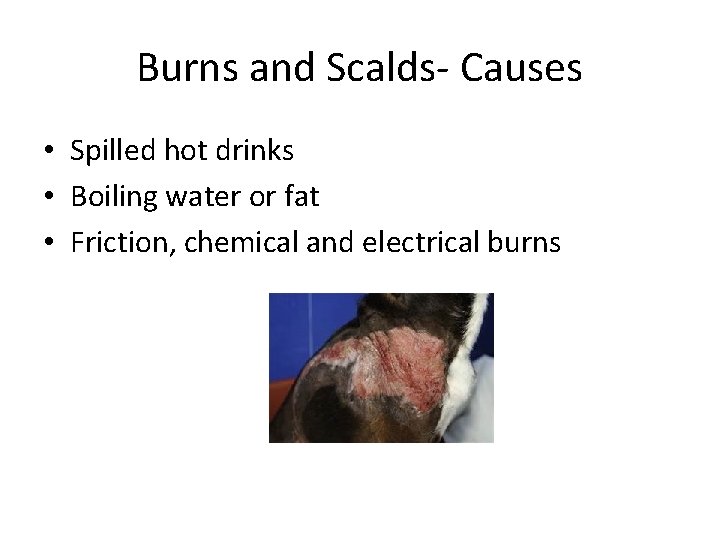 Burns and Scalds- Causes • Spilled hot drinks • Boiling water or fat •