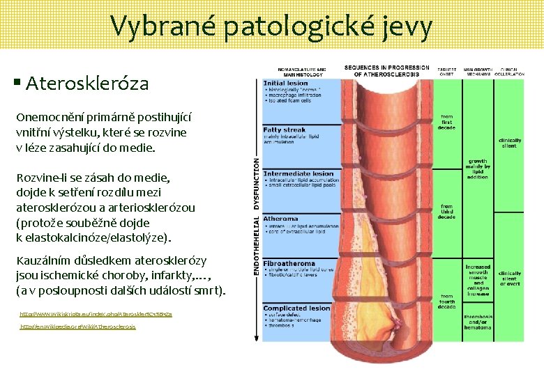 Vybrané patologické jevy § Ateroskleróza Onemocnění primárně postihující vnitřní výstelku, které se rozvine v