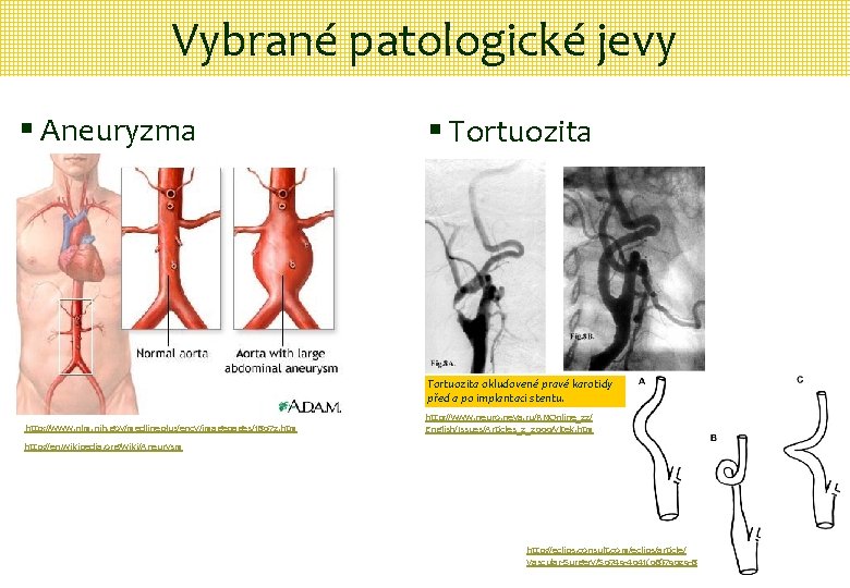 Vybrané patologické jevy § Aneuryzma § Tortuozita okludovené pravé karotidy před a po implantaci