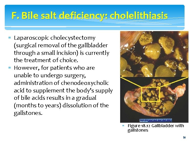 F. Bile salt deficiency: cholelithiasis Laparoscopic cholecystectomy (surgical removal of the gallbladder through a