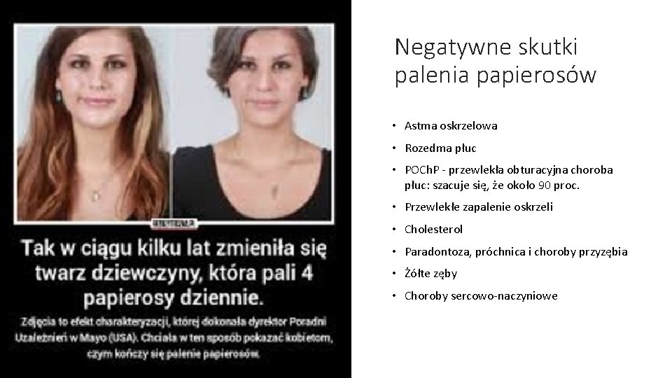 Negatywne skutki palenia papierosów • Astma oskrzelowa • Rozedma płuc • POCh. P -