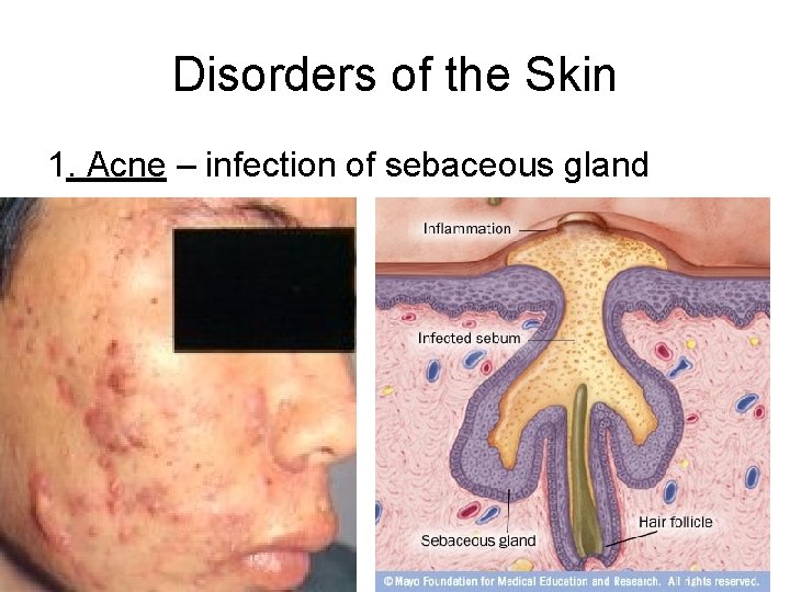 Disorders of the Skin 1. Acne – infection of sebaceous gland 