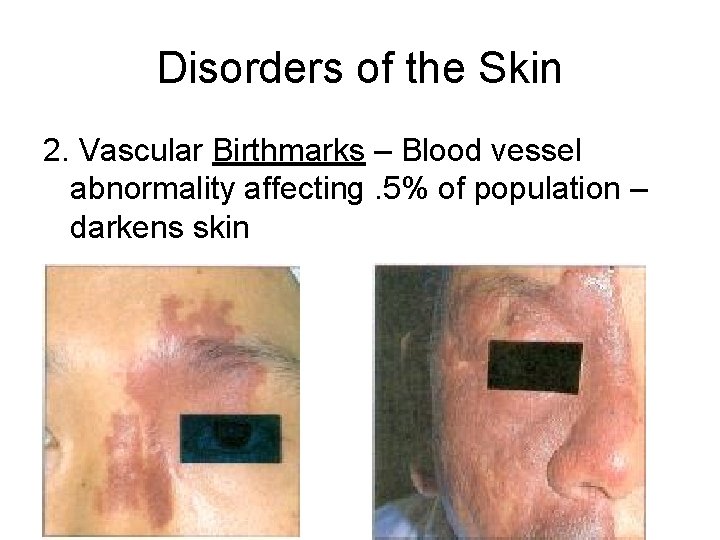 Disorders of the Skin 2. Vascular Birthmarks – Blood vessel abnormality affecting. 5% of