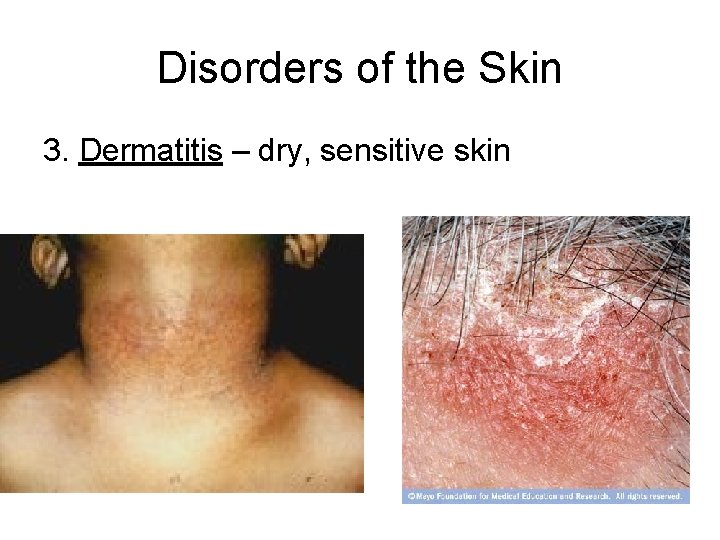 Disorders of the Skin 3. Dermatitis – dry, sensitive skin 