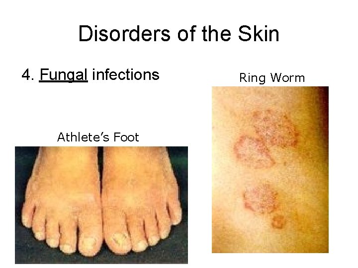 Disorders of the Skin 4. Fungal infections Athlete’s Foot Ring Worm 