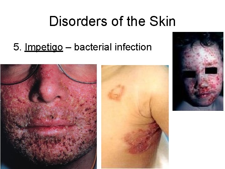 Disorders of the Skin 5. Impetigo – bacterial infection 