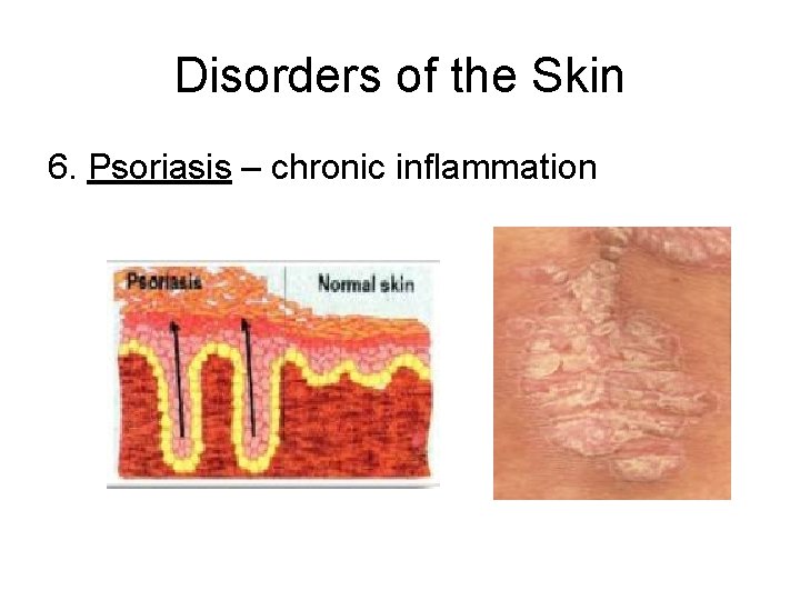 Disorders of the Skin 6. Psoriasis – chronic inflammation 