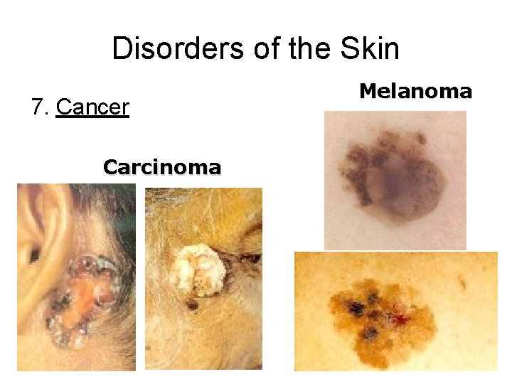 Disorders of the Skin 7. Cancer Carcinoma Melanoma 