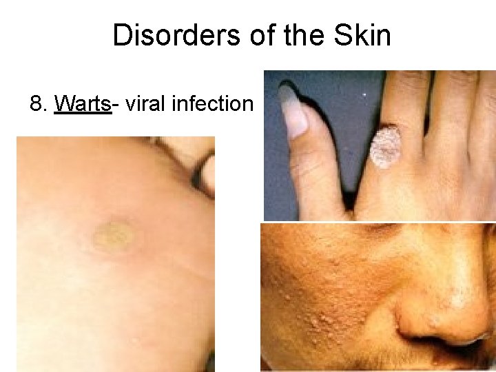 Disorders of the Skin 8. Warts- viral infection 