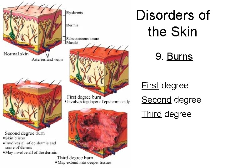 Disorders of the Skin 9. Burns First degree Second degree Third degree 