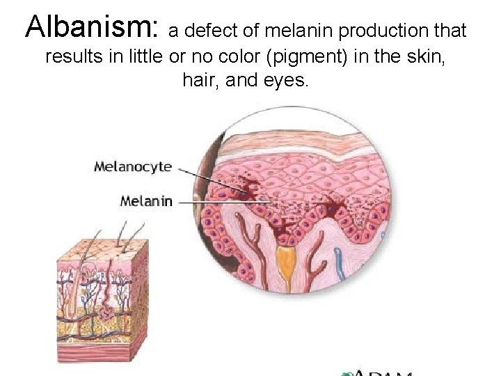 Albanism: a defect of melanin production that results in little or no color (pigment)