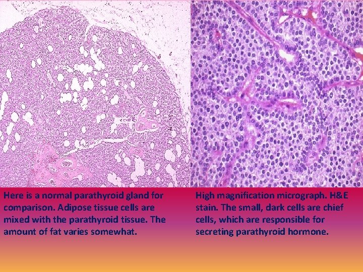 Here is a normal parathyroid gland for comparison. Adipose tissue cells are mixed with