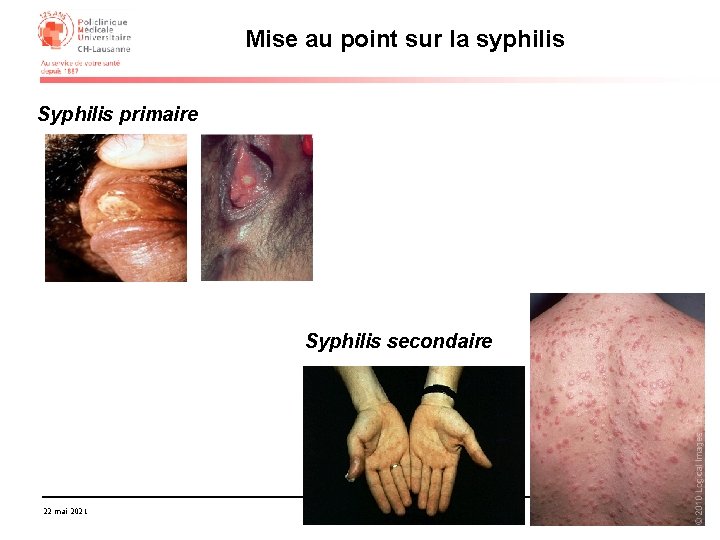 Mise au point sur la syphilis Syphilis primaire Syphilis secondaire 22 mai 2021 