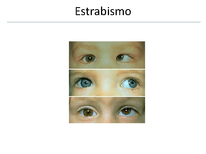 Estrabismo 