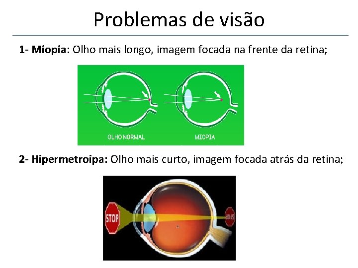 Problemas de visão 1 - Miopia: Olho mais longo, imagem focada na frente da