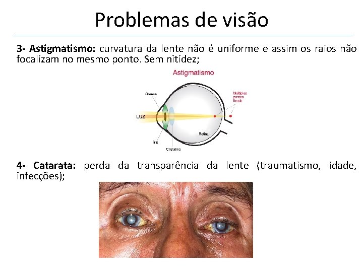 Problemas de visão 3 - Astigmatismo: curvatura da lente não é uniforme e assim