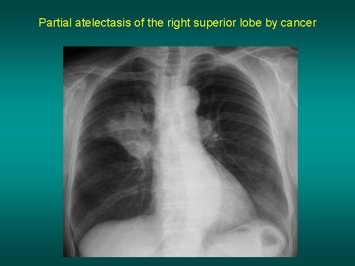 Partial atelectasis of the right superior lobe by cancer 
