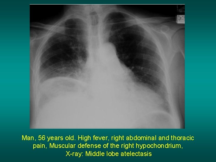 Man, 56 years old. High fever, right abdominal and thoracic pain, Muscular defense of