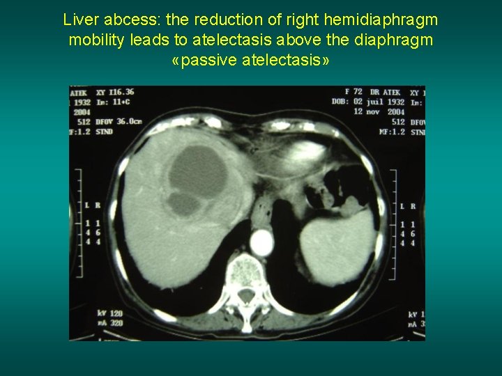 Liver abcess: the reduction of right hemidiaphragm mobility leads to atelectasis above the diaphragm
