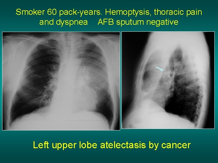 Smoker 60 pack-years. Hemoptysis, thoracic pain and dyspnea AFB sputum negative Left upper lobe