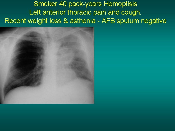 Smoker 40 pack-years Hemoptisis Left anterior thoracic pain and cough. Recent weight loss &