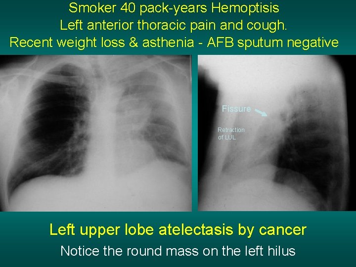 Smoker 40 pack-years Hemoptisis Left anterior thoracic pain and cough. Recent weight loss &