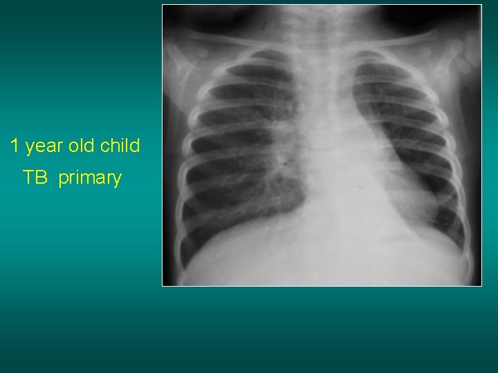1 year old child TB primary 