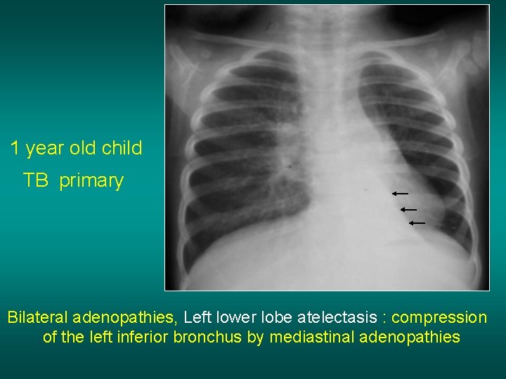 1 year old child TB primary Bilateral adenopathies, Left lower lobe atelectasis : compression