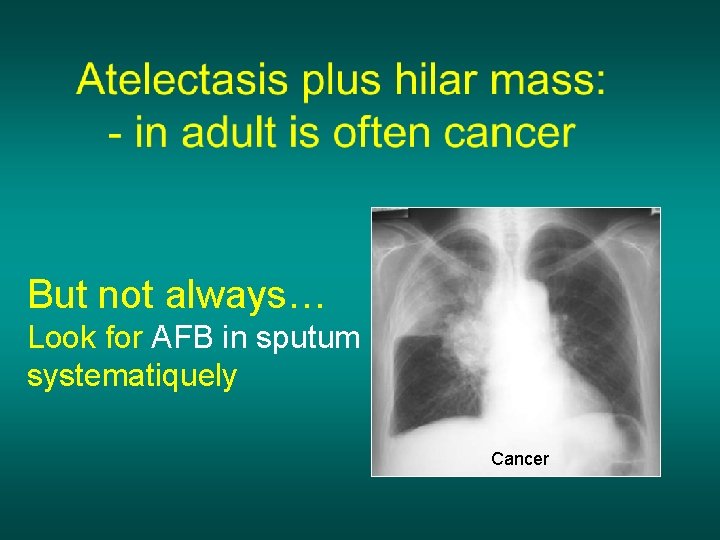 But not always… Look for AFB in sputum systematiquely Cancer 