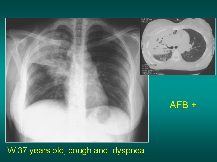 AFB + W 37 years old, cough and dyspnea. 