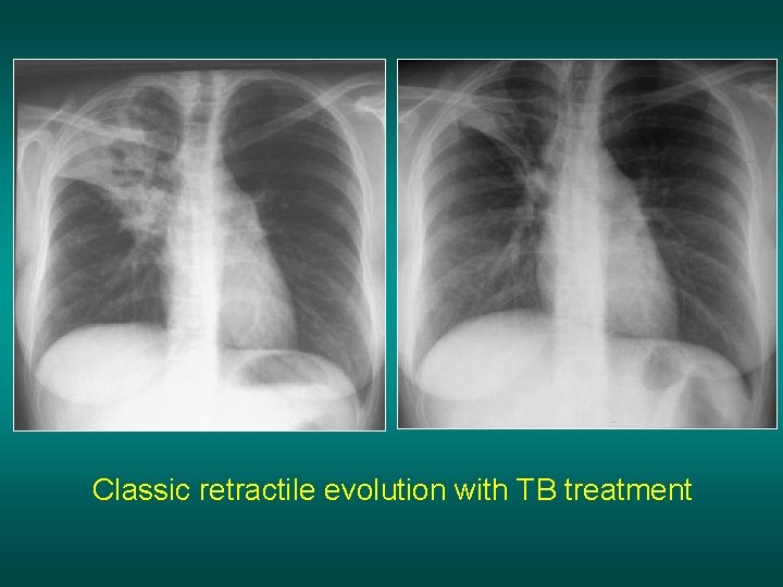 Classic retractile evolution with TB treatment 