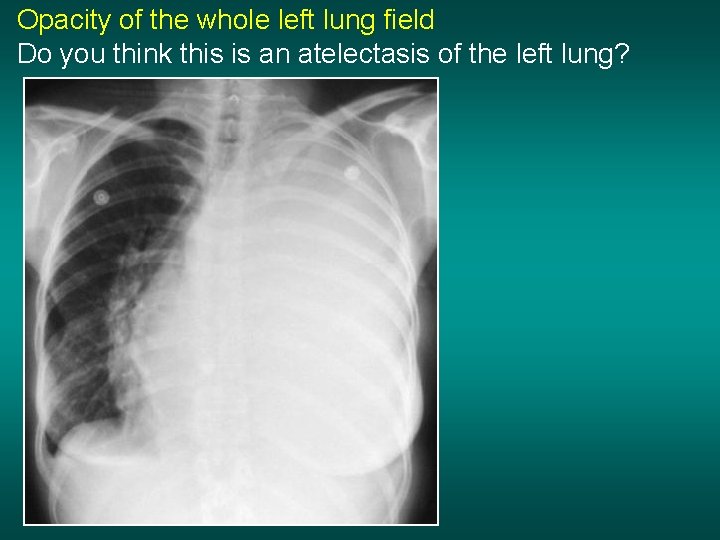 Opacity of the whole left lung field Do you think this is an atelectasis