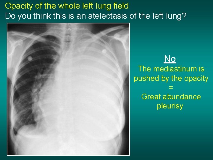 Opacity of the whole left lung field Do you think this is an atelectasis