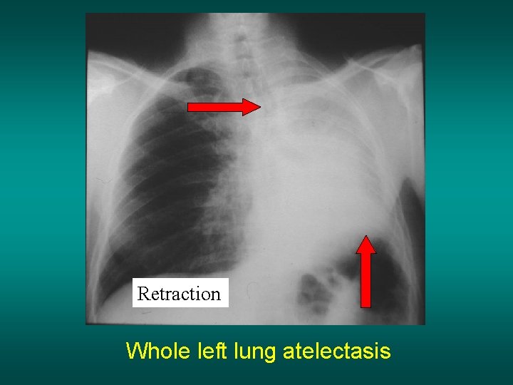 Retraction Whole left lung atelectasis 