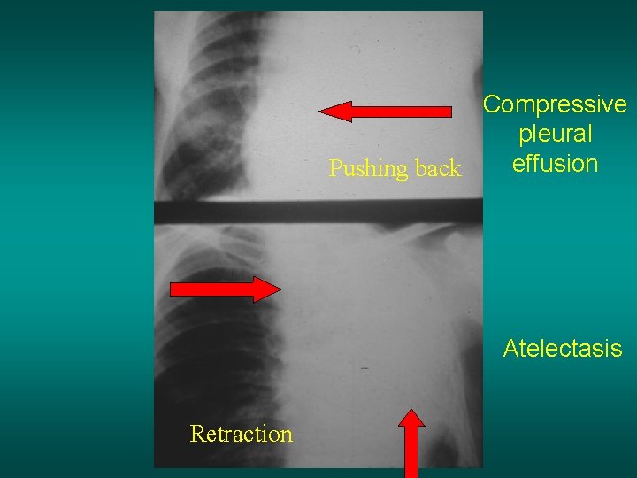 Compressive pleural effusion Pushing back Atelectasis Retraction 