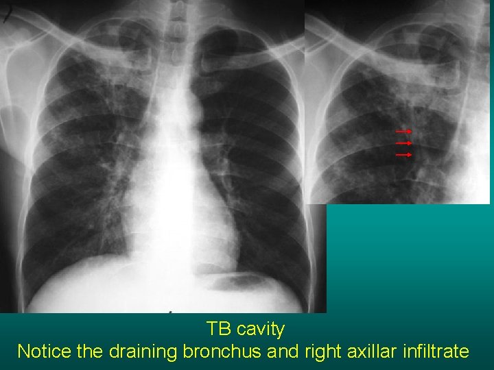 TB cavity Notice the draining bronchus and right axillar infiltrate 