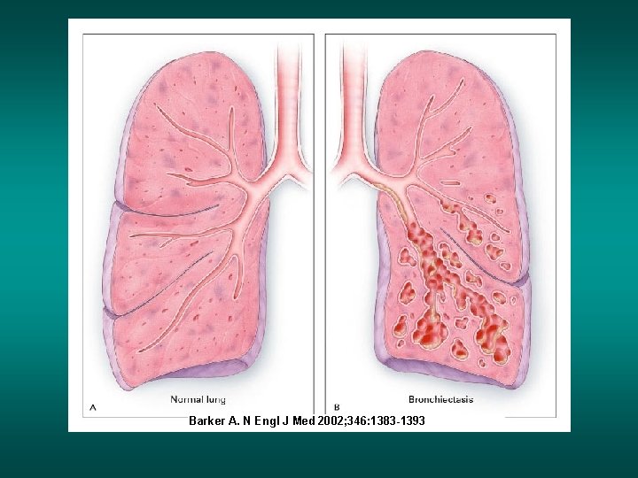 Barker A. N Engl J Med 2002; 346: 1383 -1393 