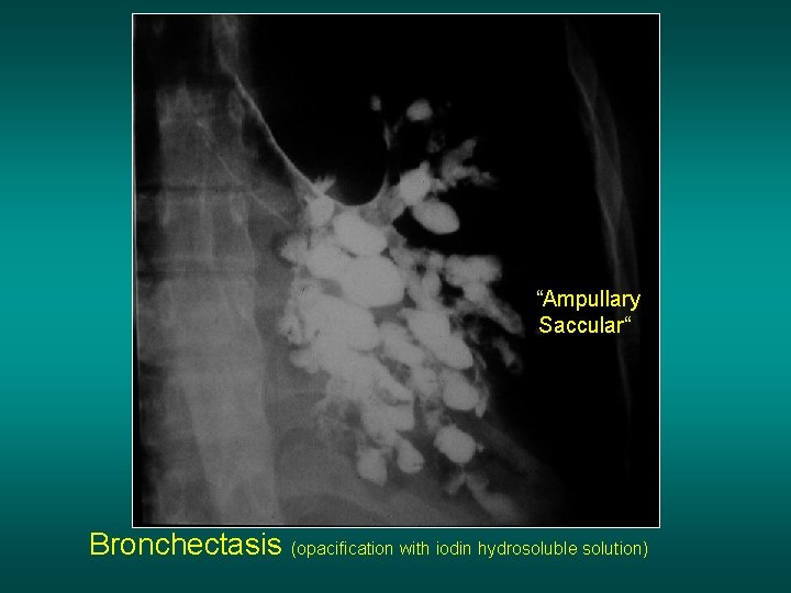 “Ampullary Saccular“ Bronchectasis (opacification with iodin hydrosoluble solution) 