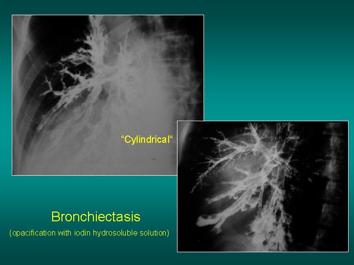 “Cylindrical“ Bronchiectasis (opacification with iodin hydrosoluble solution) 