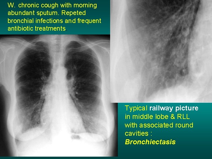 W. chronic cough with morning abundant sputum. Repeted bronchial infections and frequent antibiotic treatments.