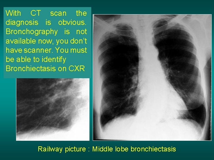 With CT scan the diagnosis is obvious. Bronchography is not available now, you don’t