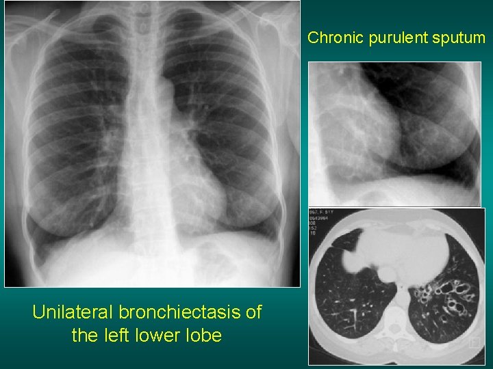 Chronic purulent sputum Unilateral bronchiectasis of the left lower lobe 