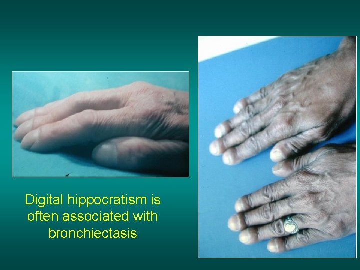 Digital hippocratism is often associated with bronchiectasis 