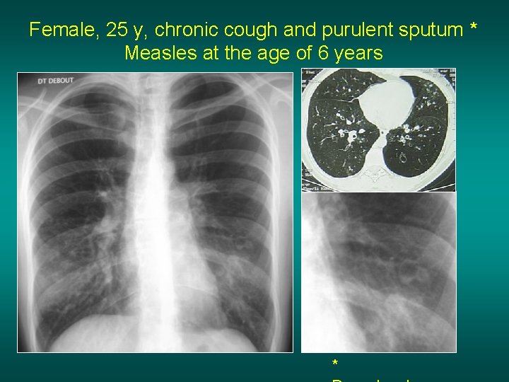 Female, 25 y, chronic cough and purulent sputum * Measles at the age of