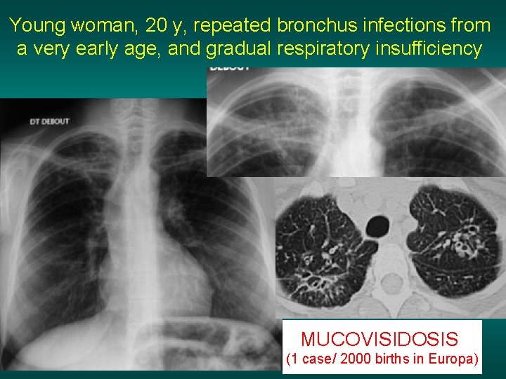 Young woman, 20 y, repeated bronchus infections from a very early age, and gradual