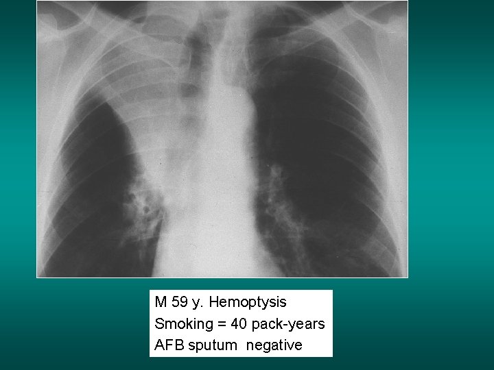 M 59 y. Hemoptysis Smoking = 40 pack-years AFB sputum negative 
