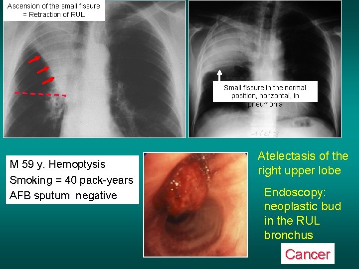 Ascension of the small fissure = Retraction of RUL Small fissure in the normal